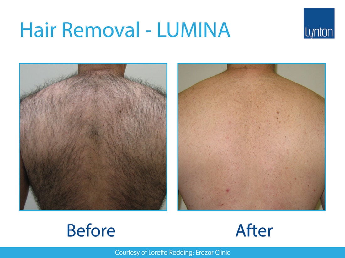 Before-and-after pictures of a man’s back with IPL hair removal.