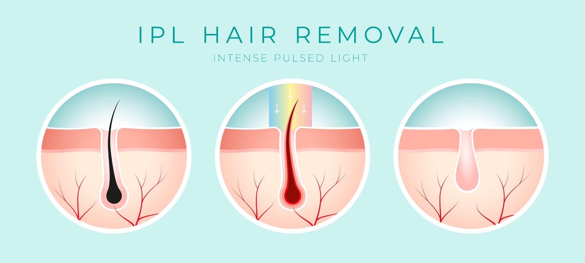 IPL Laser hair removal illustration